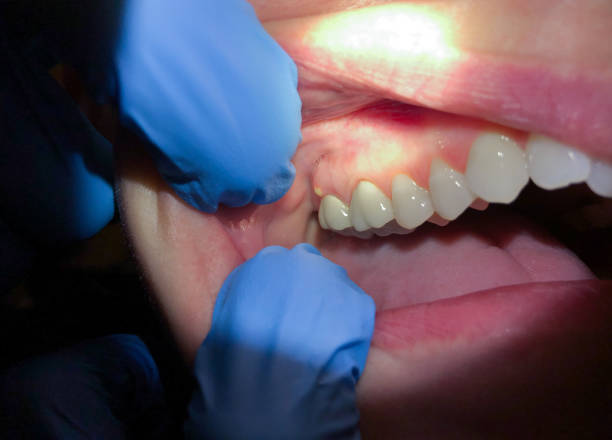 Best Emergency Wisdom Teeth Removal in Hillsboro, MO